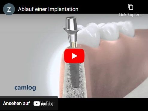 Ablauf einer Implantation